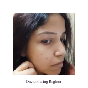 Before Image of client first day using reglora cream